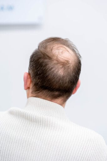 Een man met zichtbare haaruitval op de kruin, een van de veelvoorkomende redenen voor een haarbehandeling.