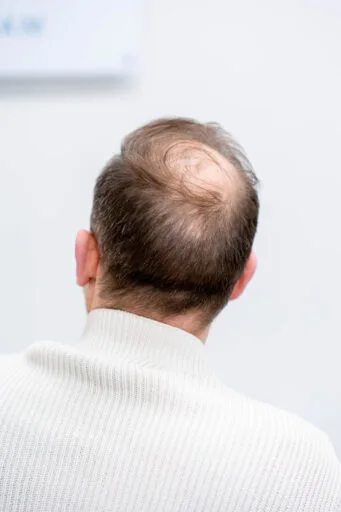 Een man met zichtbare haaruitval op de kruin, een van de veelvoorkomende redenen voor een haarbehandeling.