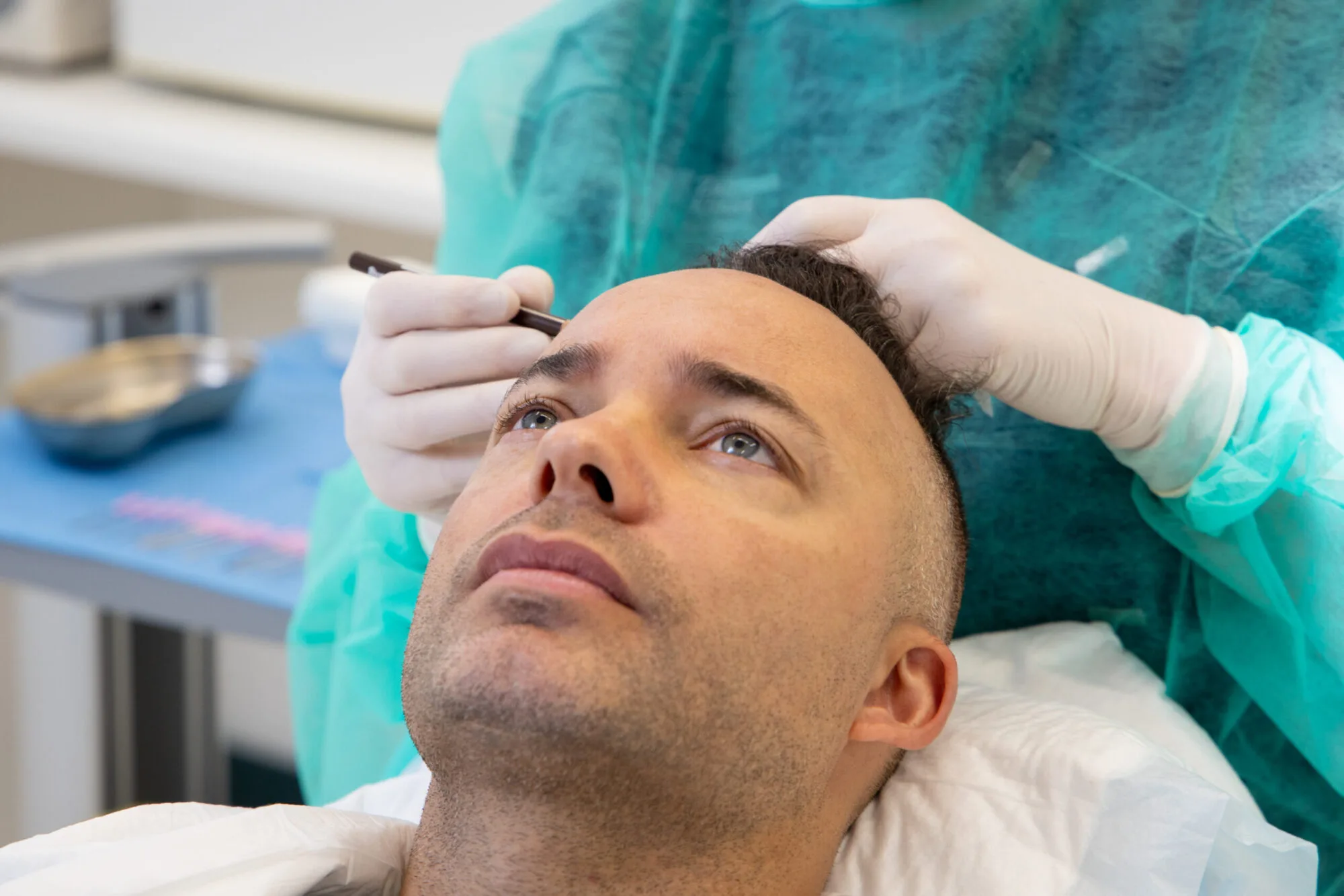 Demy de Zeeuw undergoes a hair transplant, with a specialist accurately marking the hairline.