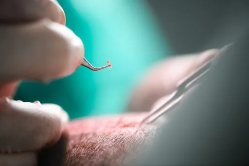 Close-up van een haarfollikel-graft die met een pincet nauwkeurig wordt geplaatst in de hoofdhuid tijdens een haartransplantatieprocedure.
