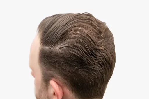 Achteraanzicht van een man met netjes naar achter gekamd haar en herstelde haarkrans na een haartransplantatie.