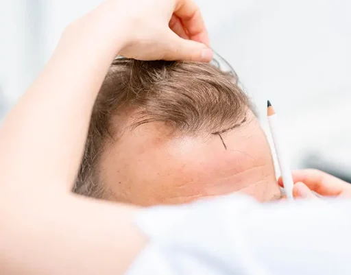 Man houdt een transparante haarlijnmal tegen zijn voorhoofd om de gewenste haarlijn te bepalen ter voorbereiding op een haartransplantatie.
