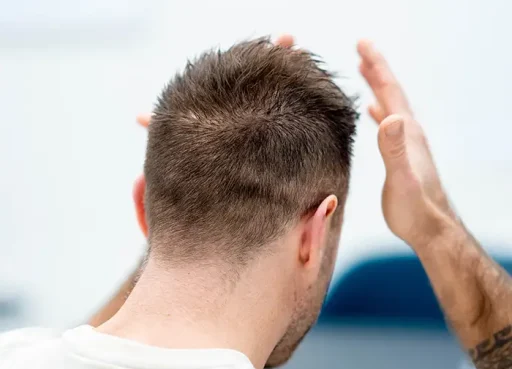 Achteraanzicht van man met volle haarkrans na haartransplantatie, met kortgeschoren nek en handen die de haardensiteit tonen.
