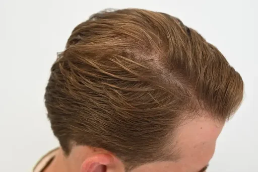 Bovenaanzicht van het hoofd van een man met licht dunner wordend haar, voorafgaand aan haartransplantatie.