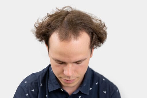 Jurrien Hendrikx met zichtbare haaruitval, kijkt naar beneden om de dunner wordende haardos te laten zien.