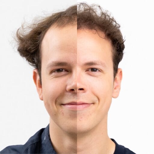 Jurriën Hendrikx voor en na zijn haartransplantatie, met een zichtbaar vollere haardos en herstelde haarlijn.