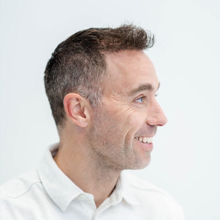 Zijaanzicht van Sjors Ultee na haartransplantatie met volle haarlijn.