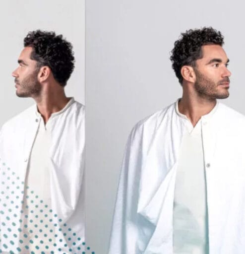 Voor en na haartransplantatie: een transformatie met vollere haargroei dankzij een speciale aanbieding.