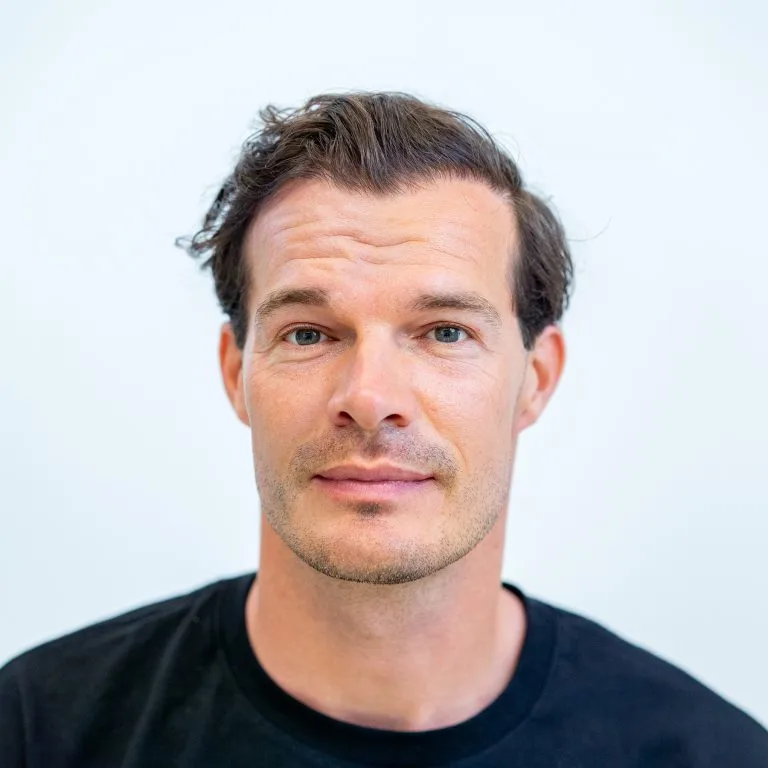 Frontaal portret van man na haartransplantatie, toont verbeterde haarlijn en vollere haargroei