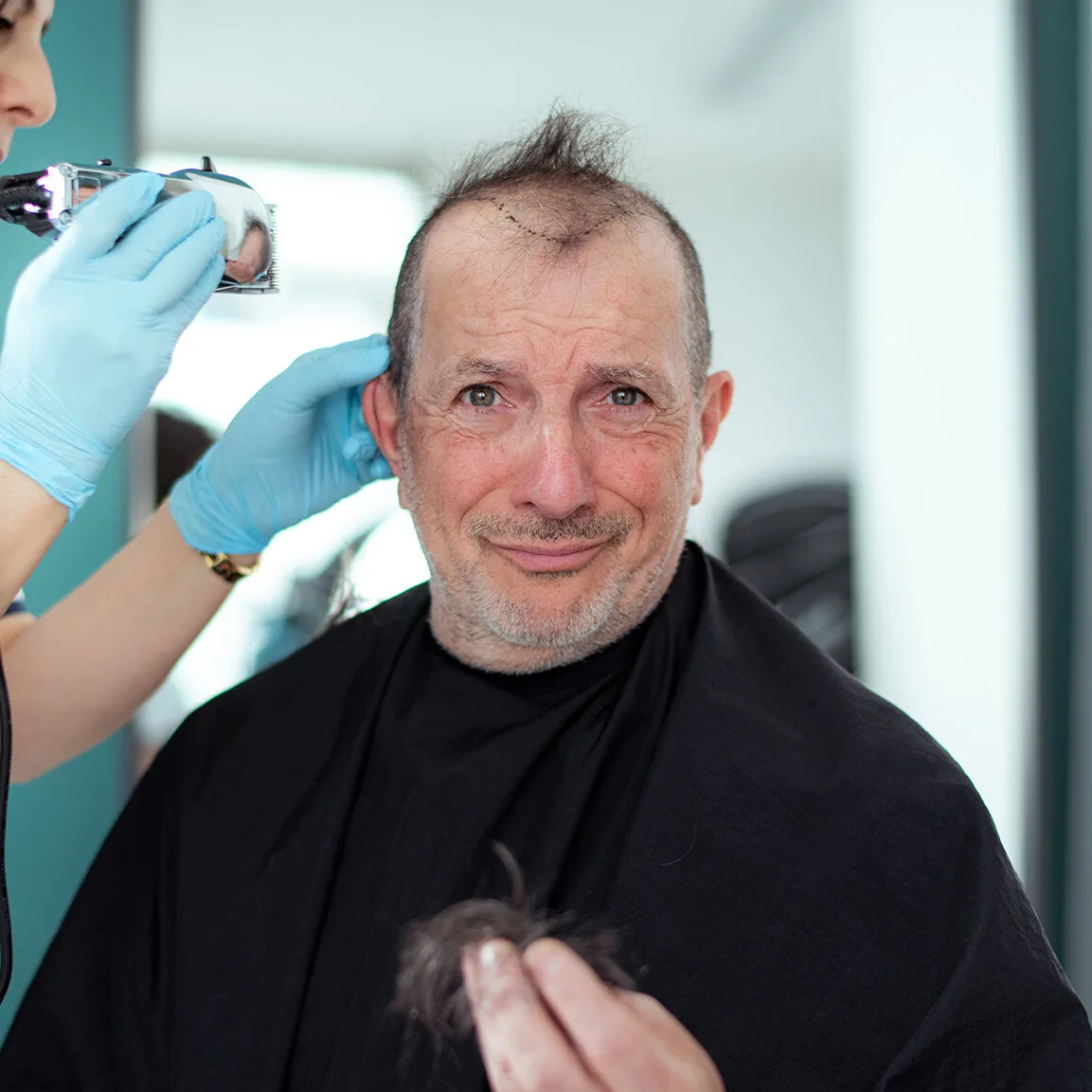 Alain Caron's hair is shaved off prior to a hair transplant.