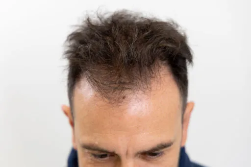 Haarverlies op de kruin is een veelvoorkomende vorm van kaalheid bij mannen. Op deze foto is de achterkant van Jeroen Spitzenberger’s hoofd te zien vóór zijn haartransplantatie, waarbij de uitdunning op de kruin duidelijk zichtbaar is. Dankzij de expertise van de Zantman Kliniek wordt een natuurlijke haardichtheid hersteld met geavanceerde technieken. Een haartransplantatie kan een effectieve en blijvende oplossing bieden voor dit type haarverlies.