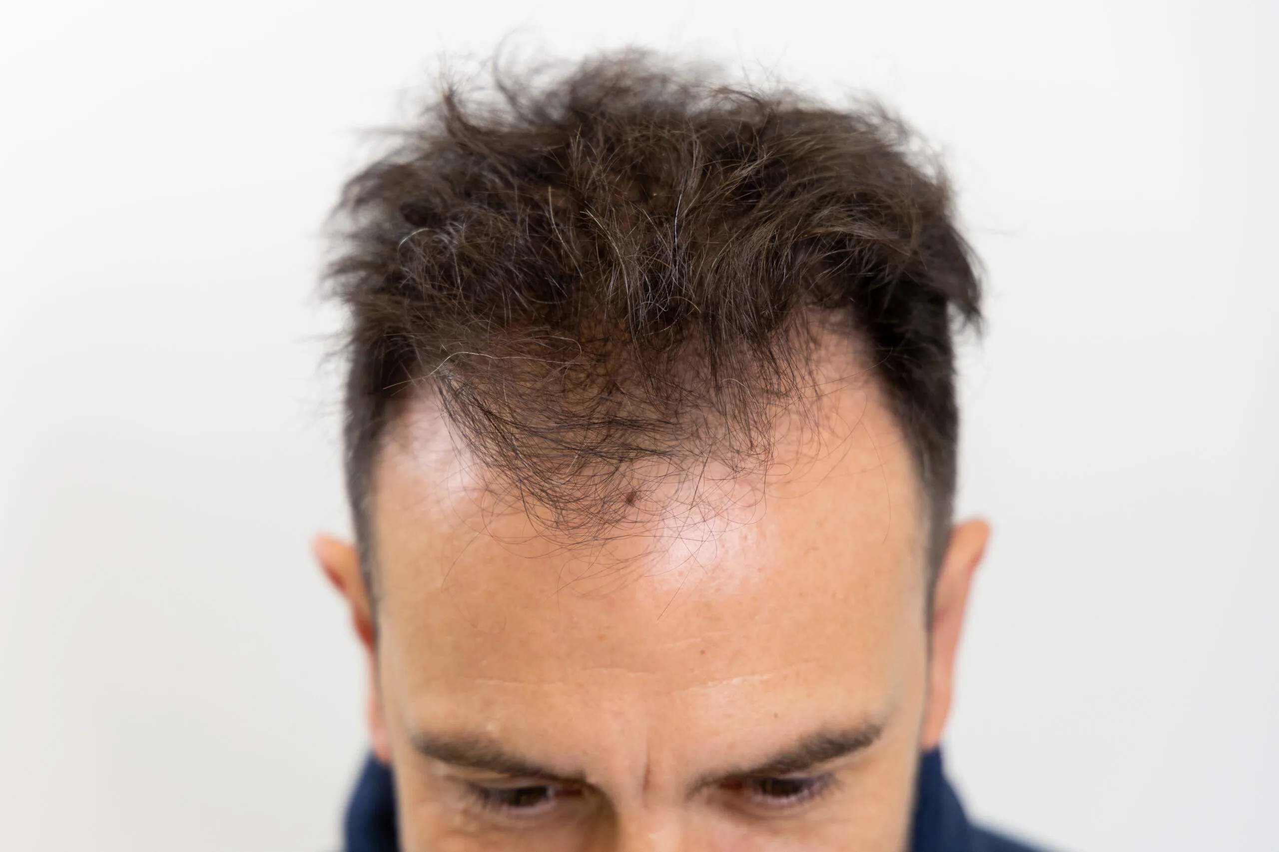 Hair loss on the crown is a common form of male pattern baldness. This photo shows the back of Jeroen Spitzenberger's head before his hair transplant, with thinning at the crown clearly visible. Thanks to the expertise of the Zantman Clinic , natural hair density is restored with advanced techniques. A hair transplant can provide an effective and lasting solution to this type of hair loss.