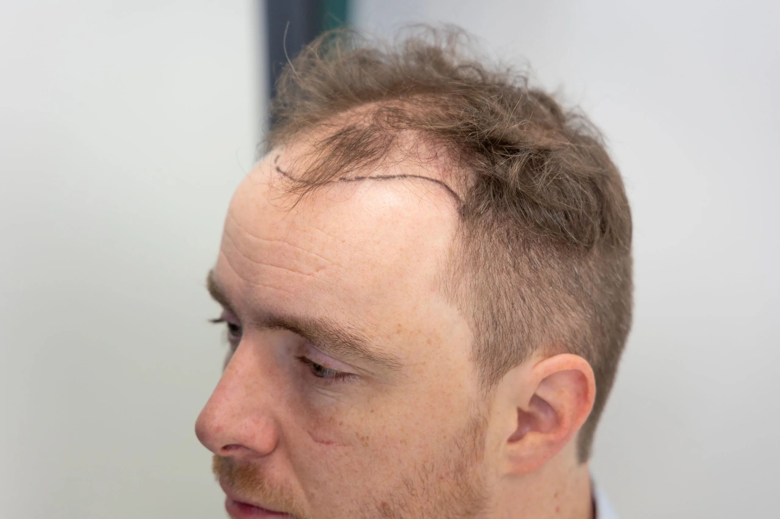 Side view of Pieter Hulst showing the treatment area for a hair transplant, marked with marker on the scalp.