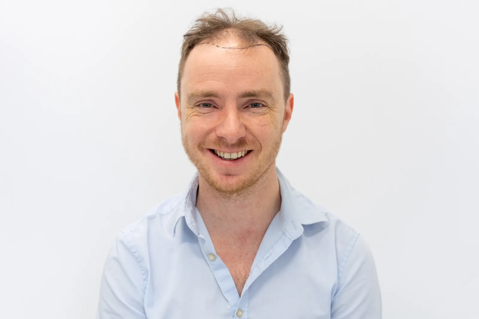 Pieter Hulst undergoes hair transplant at Zantman Clinic