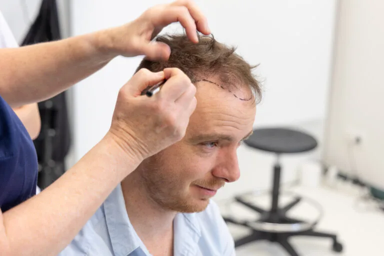 Pieter Hulst met lichtbruin haar en lichte haaruitval krijgt een haarlijn uitgetekend door een specialist als voorbereiding op een haartransplantatie.