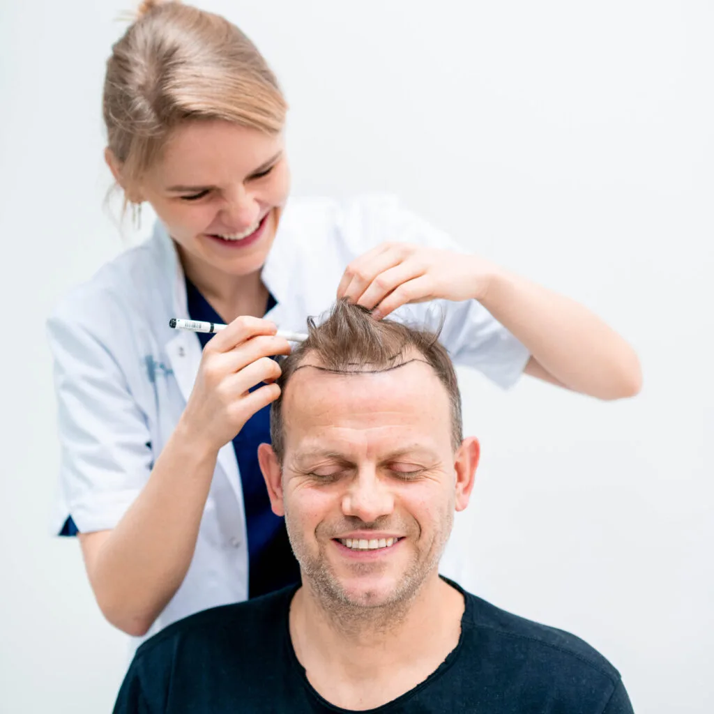 Man met kort haar en een glimlach ondergaat een haartransplantatieconsult, terwijl een specialist zijn nieuwe haarlijn uittekent.