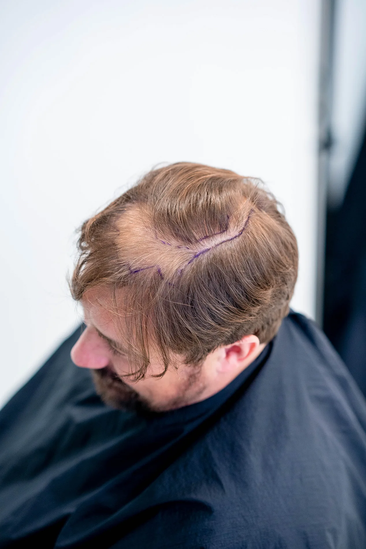 Bovenaanzicht van Joachim De Munck met ingetekende haarlijn vóór zijn haartransplantatie, zittend met zwarte kapmantel.