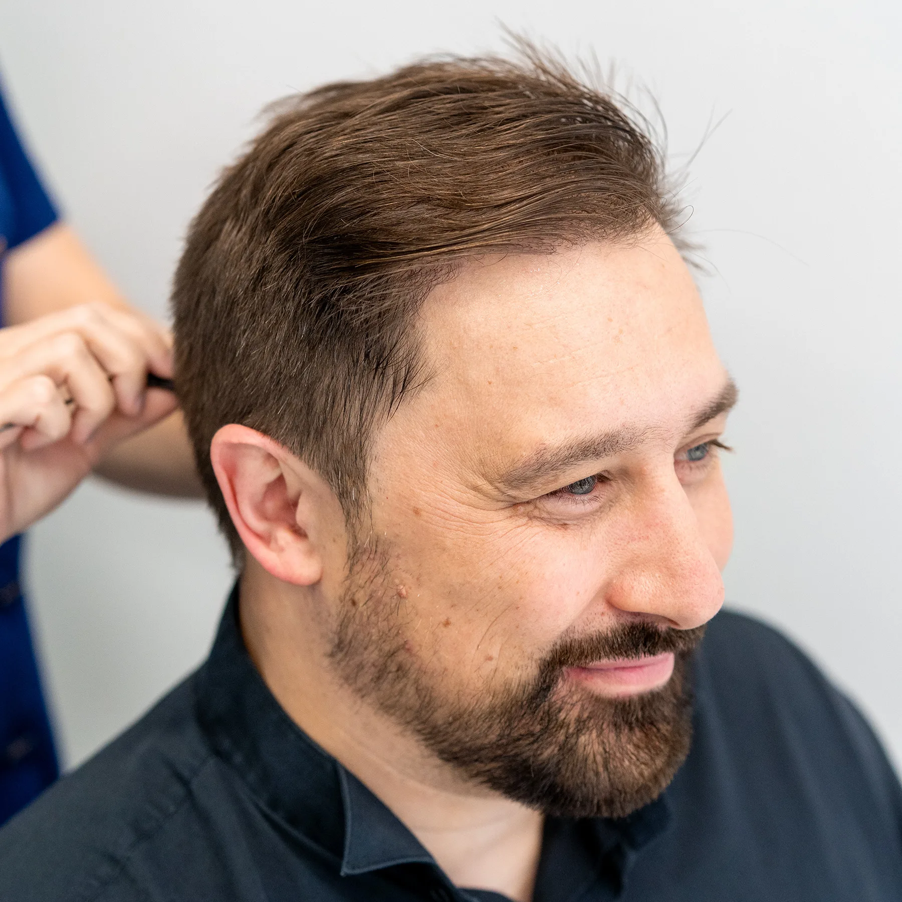 Zijaanzicht van man na haartransplantatie, toont vollere haargroei en herstelde haarlijn