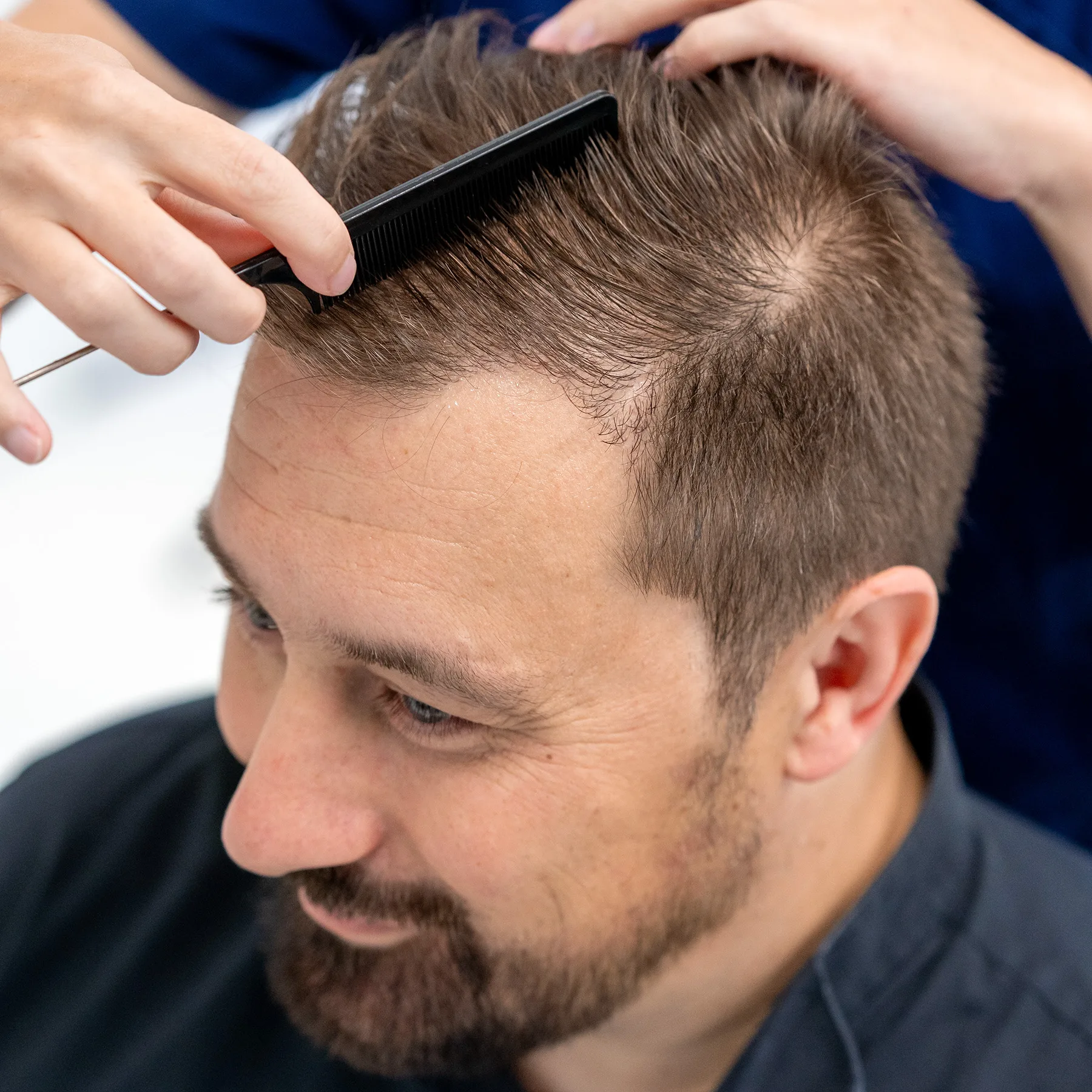 Zijaanzicht van man na haartransplantatie, waarbij een hand het haar kamt