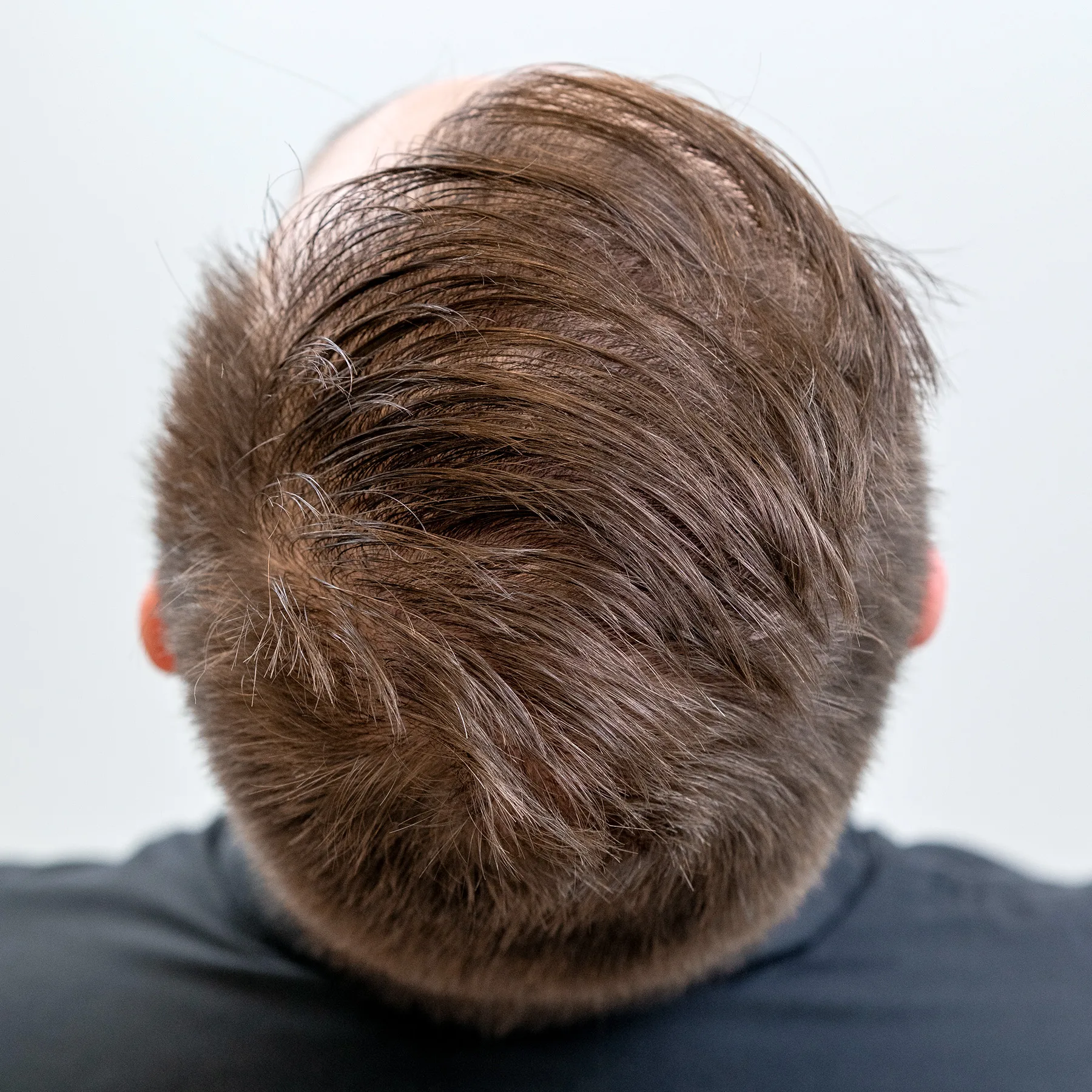 Bovenaanzicht van achterkant hoofd van man na haartransplantatie, toont dichte haargroei