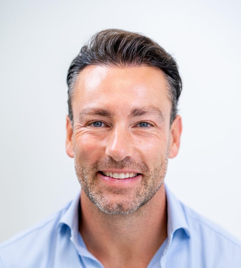 Frontaal portret van man na haartransplantatie, toont herstelde haarlijn en vollere haargroei