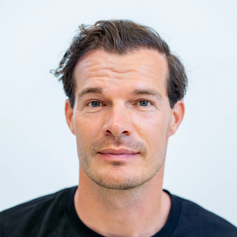 Resultaat van FUE haartransplantatie bij inhammen