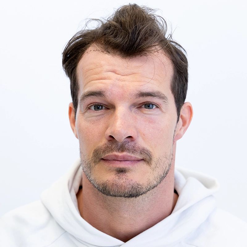 Voor foto van FUE haartransplantatie bij inhammen