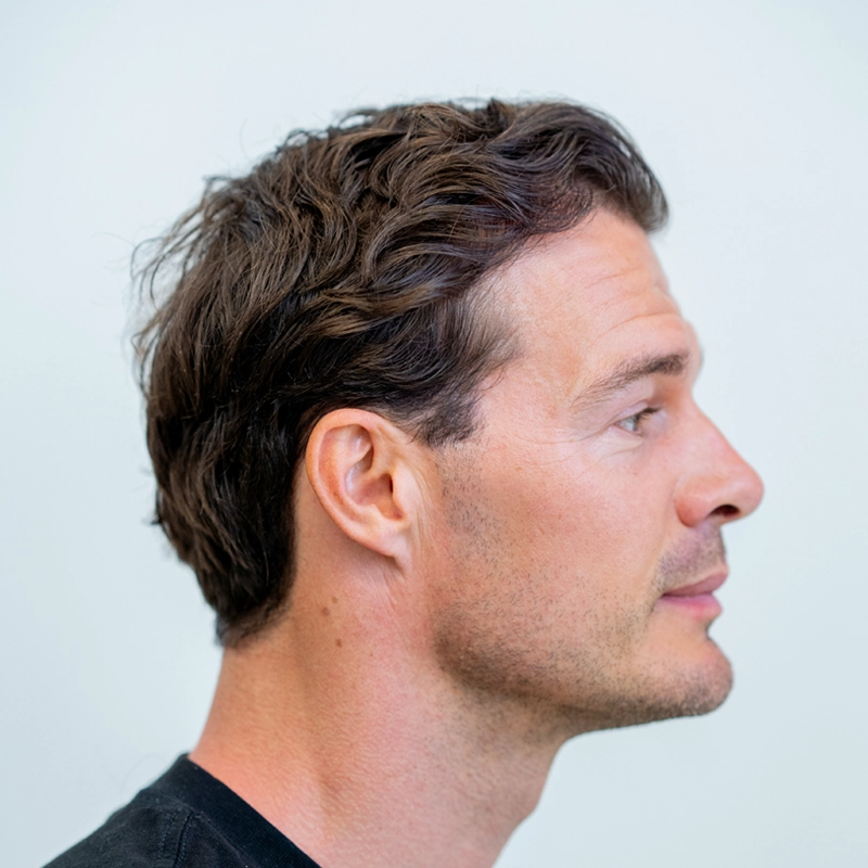 Situatie voor haartransplantatie met inhammen