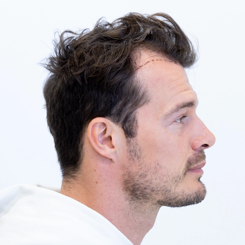 Na haartransplantatie met herstelde inhammen