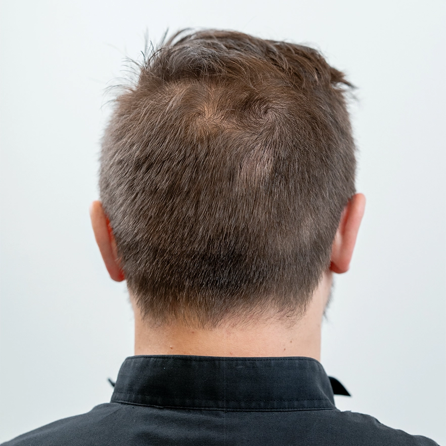 Resultaat van kruin na afloop van een haartransplantatie (achterzijde hoofd)