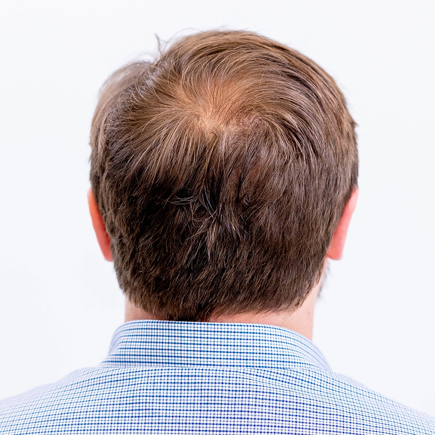 Voorbeeld van kruin voorafgaand aan haartransplantatie (achterzijde hoofd)