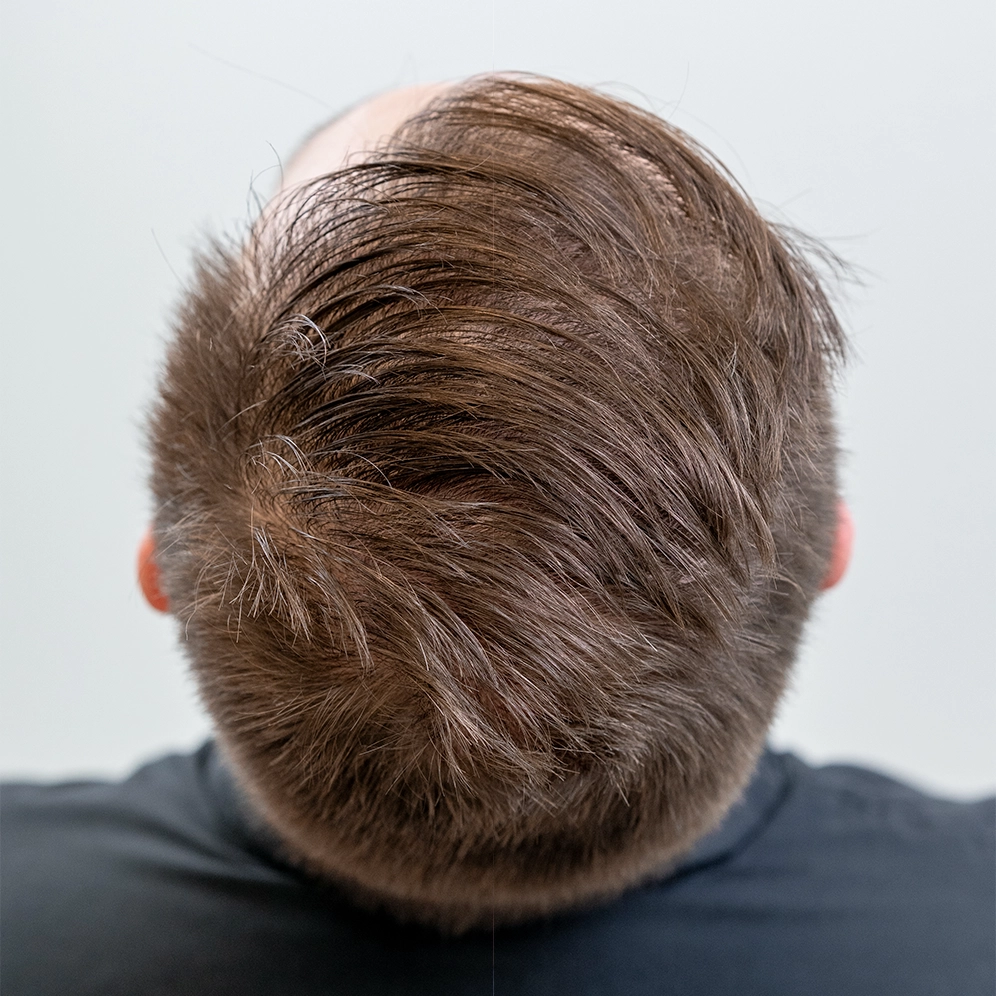 Resultaat van haarlijn en kruin na afloop van een haartransplantatie