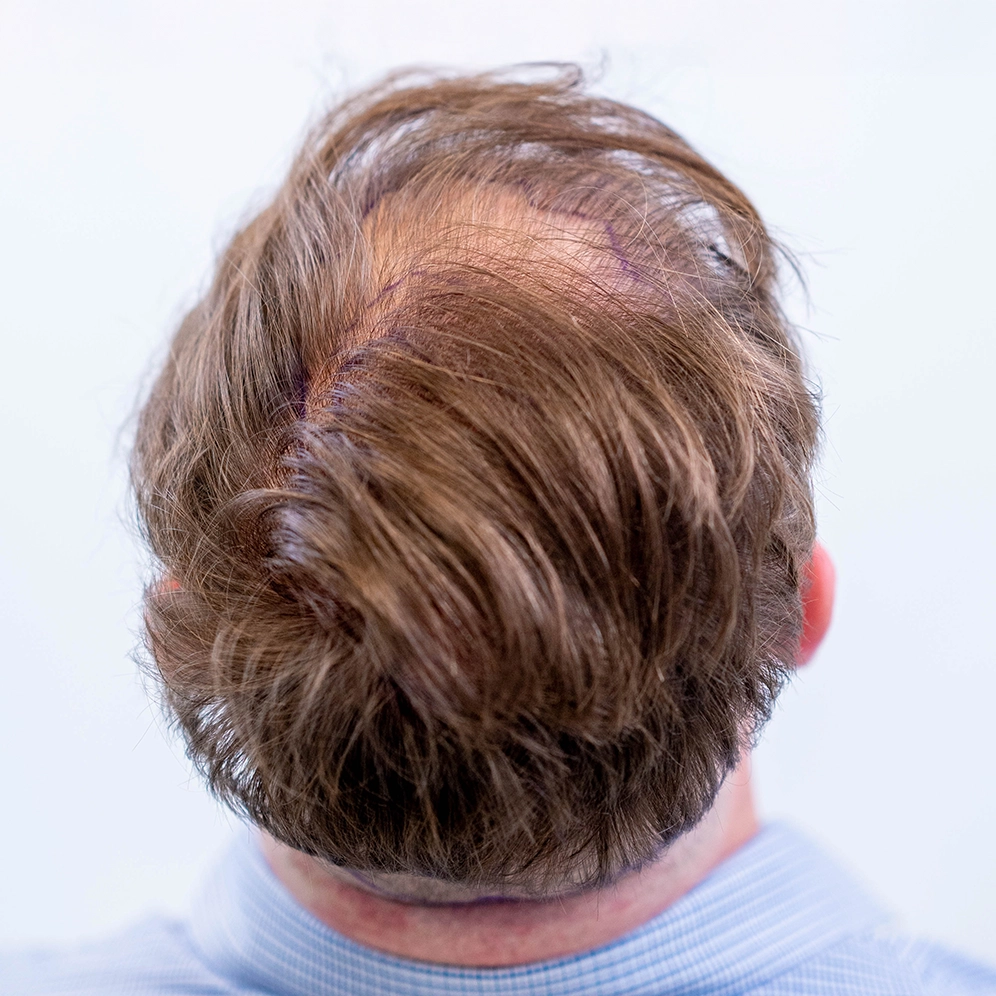 Voorbeeld van haarlijn en kruin voorafgaand aan haartransplantatie