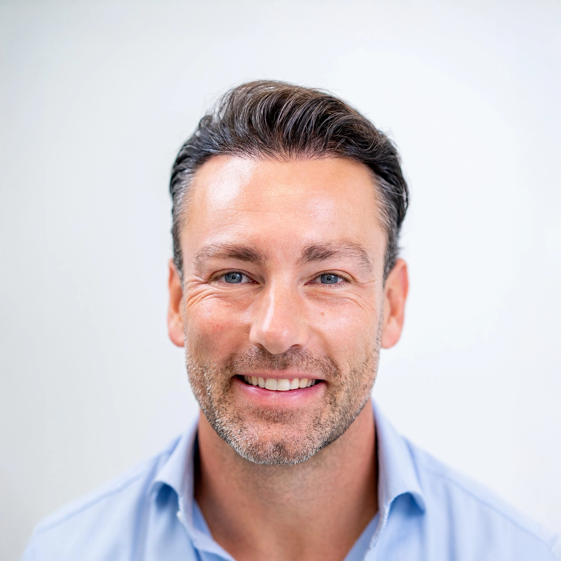 Haarlijn na FUE haartransplantatie bij man