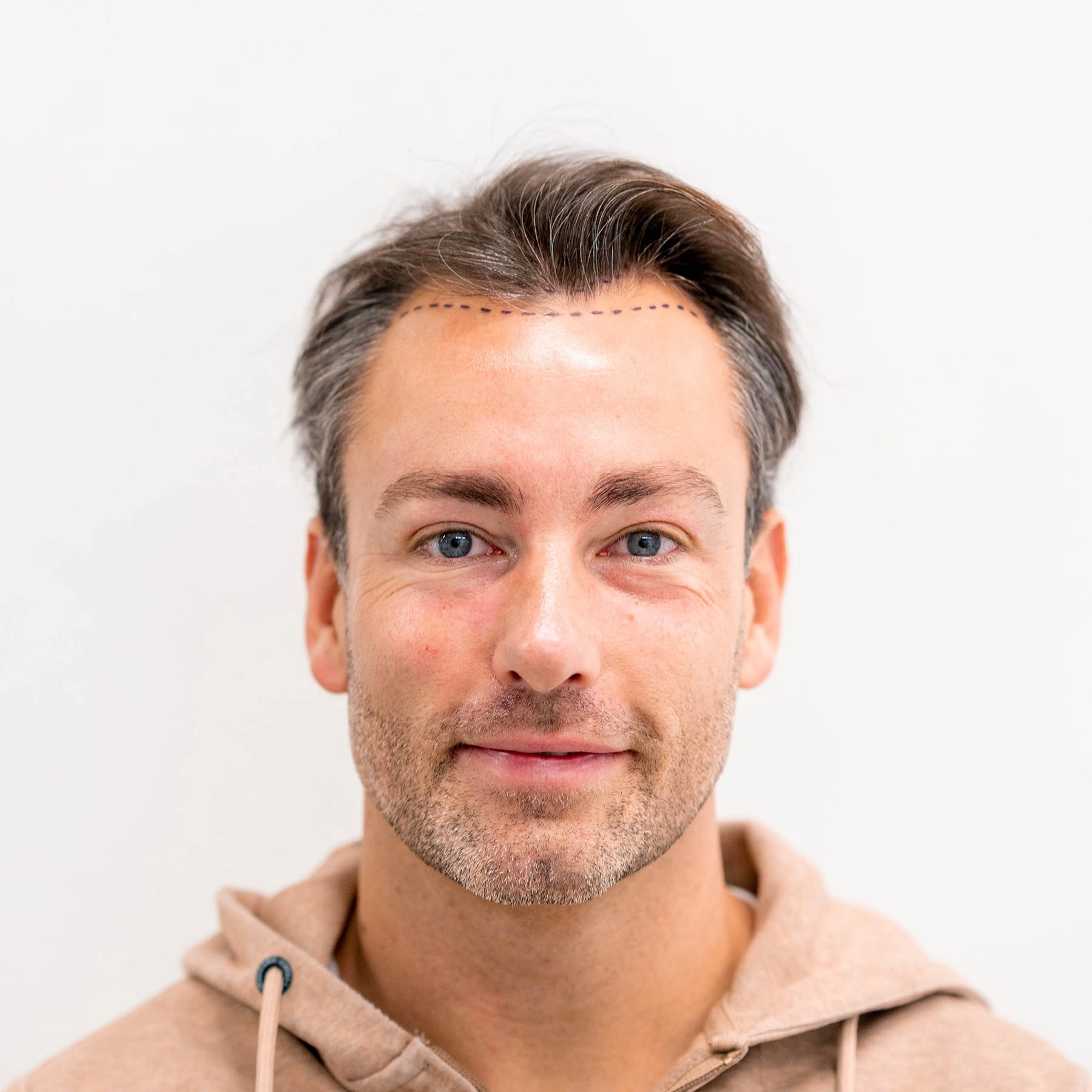 Haarlijn voor FUE haartransplantatie bij man