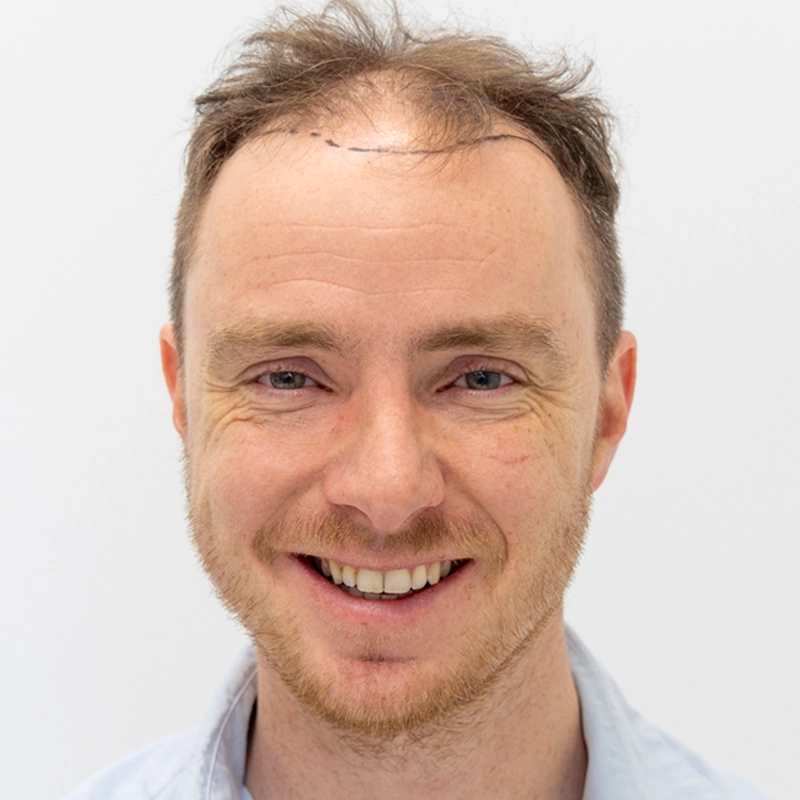 Voor foto van haarlijn en kruin voor haartransplantatie bij man