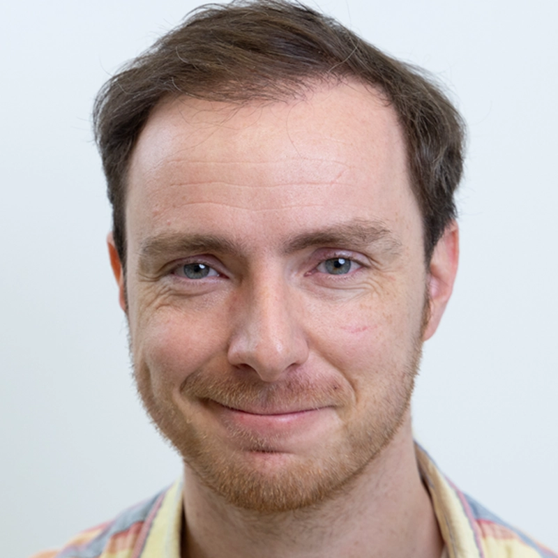 Resultaat foto van haarlijn en kruin voor haartransplantatie bij man