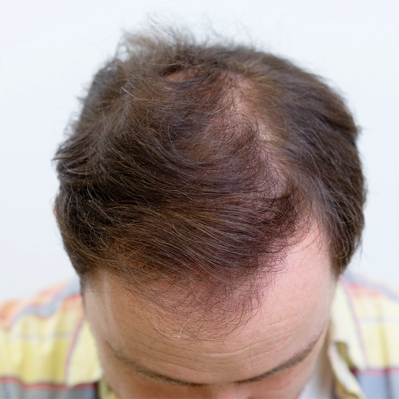 Resultaat na haartransplantatie van haarlijn en kruin bij man