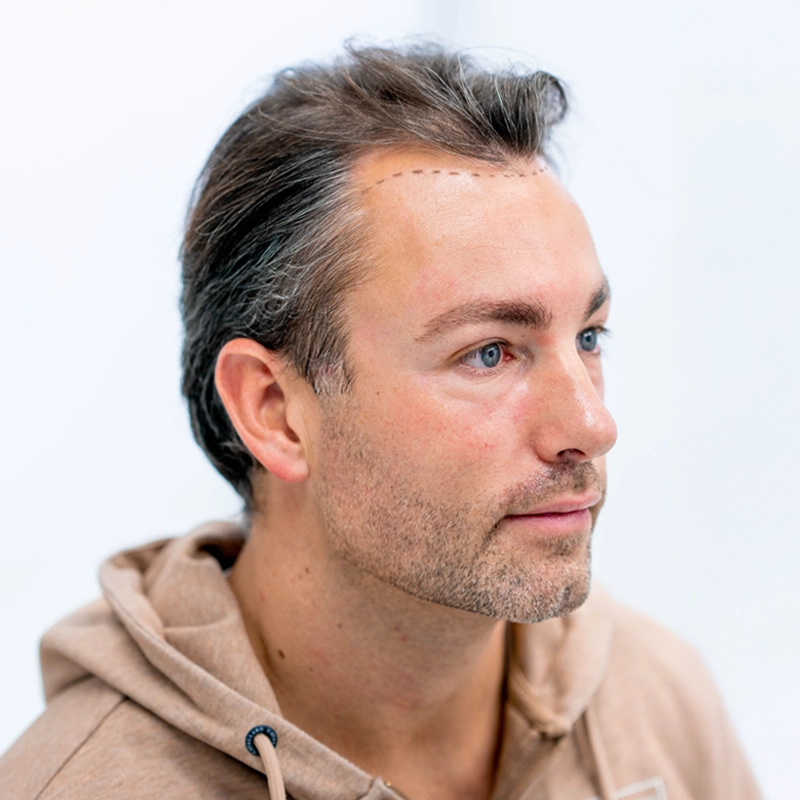 Haarlijn voor FUE haartransplantatie bij man (zijkant)