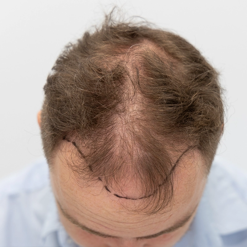 Situatie voor haartransplantatie van haarlijn en kruin bij man