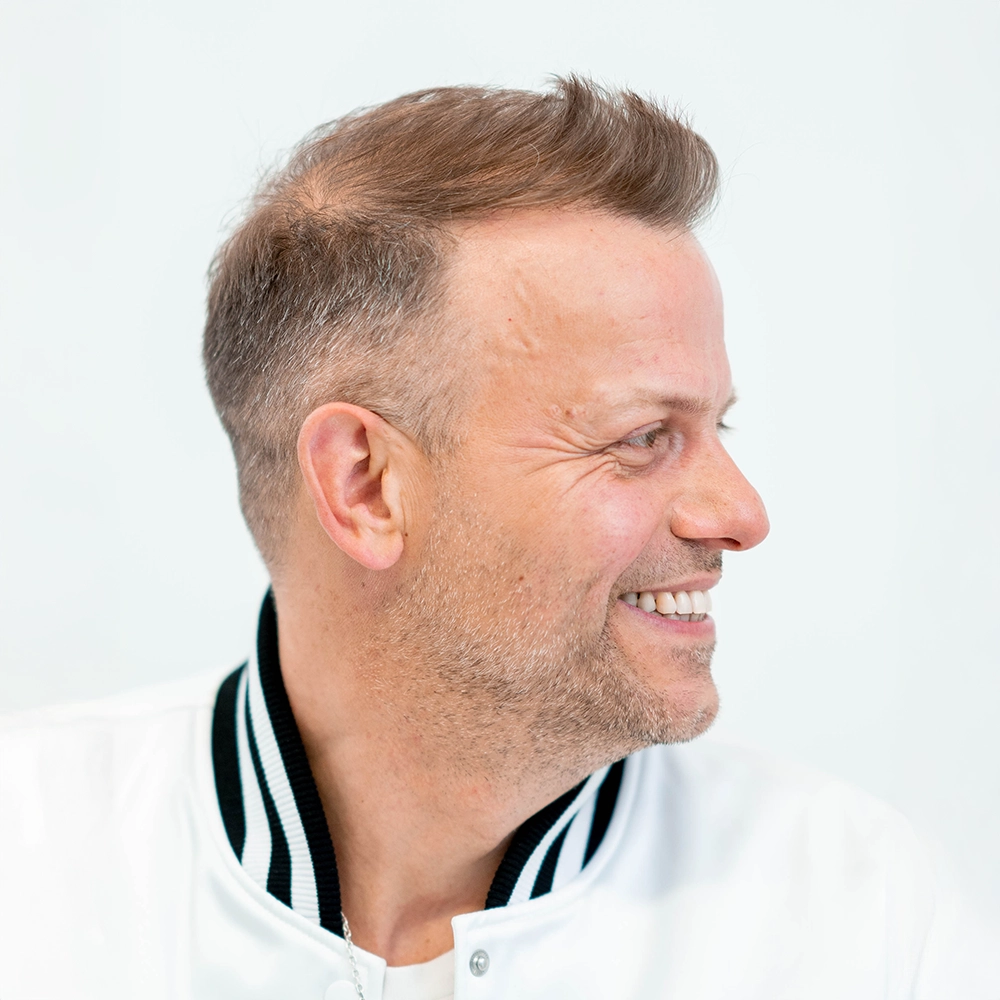 Resultaat na haartransplantatie van haarlijn en inhammen bij man