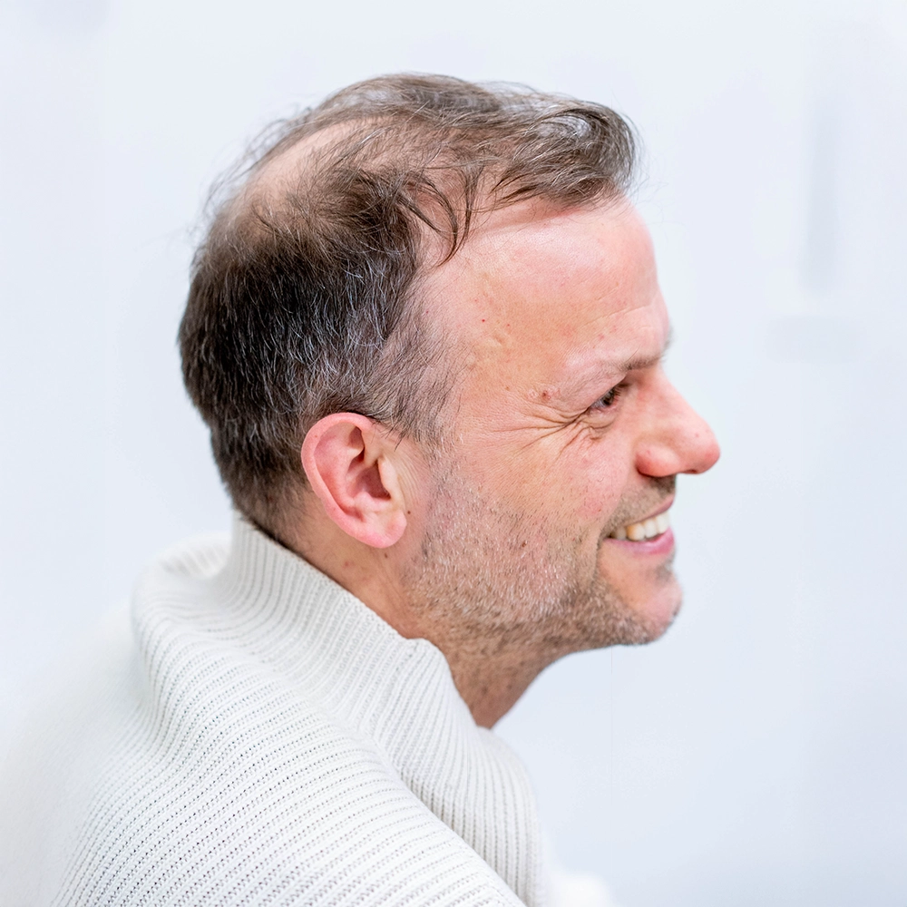 Voor foto van haarlijn en inhammen voor haartransplantatie bij man